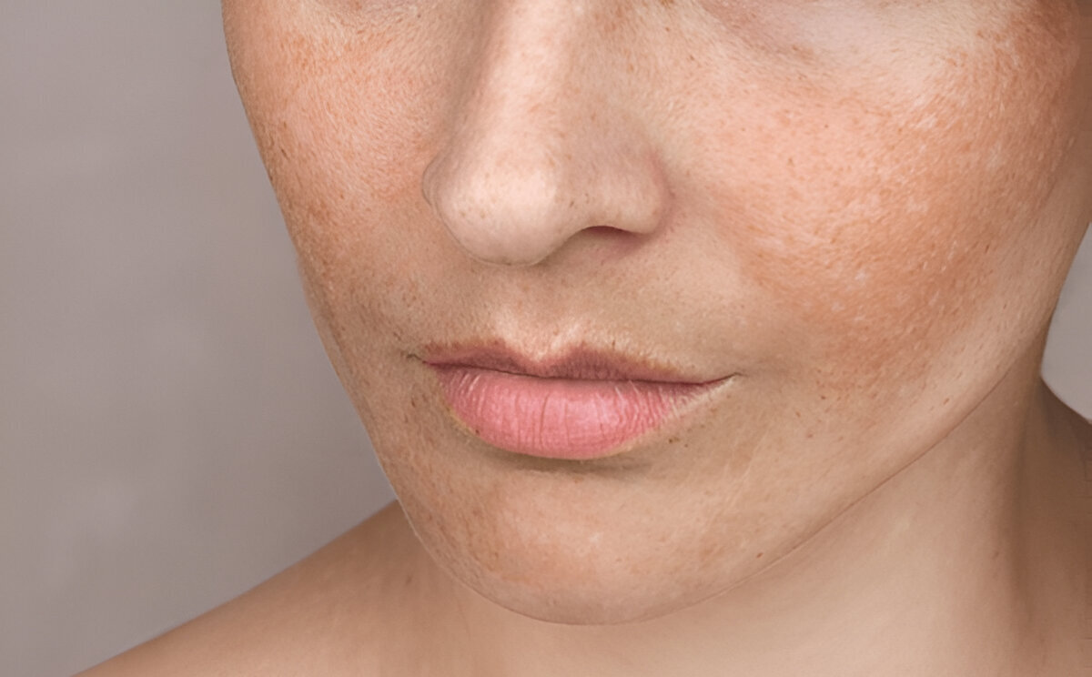 how to get rid of skin texture