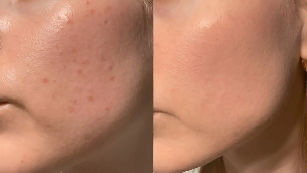 get rid of textured skin